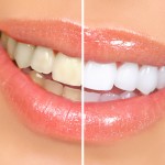 blanchiment des dents